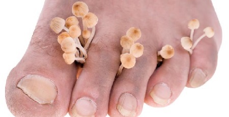 Paddestoel van voet - symptomen en behandeling, foto