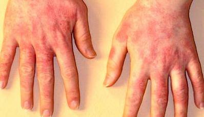 Síntomas de dermatitis de contacto