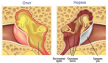 التهاب الأذن الوسطى القيحي الحاد