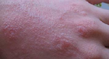 Eczema en manos de una foto