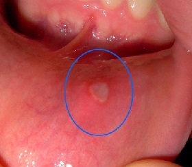 Leczenie zapalenia jamy ustnej