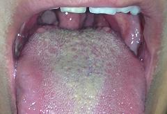ציפוי צהוב לבן על הלשון