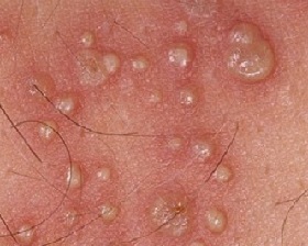 Genital herpes - treatment, symptoms and photos