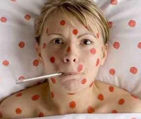Chickenpox in adults