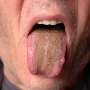 Brown coating on the tongue