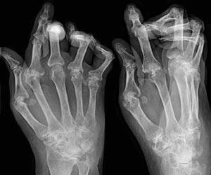 Simptomi in taktika zdravljenja revmatoidnega artritisa z ljudskimi pravili