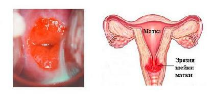 Erosion of the cervix - causes, symptoms and treatment