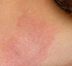 علاج التهاب الجلد التحسسي