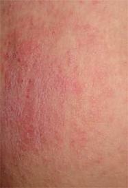 Fotografija alergijskog dermatitisa