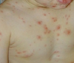 sintomi di varicella