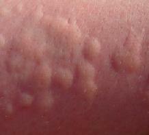 Skin allergy