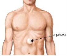 Herniated navelbehandling