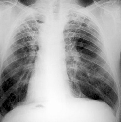 Tuberkulose - Symptome und erste Anzeichen