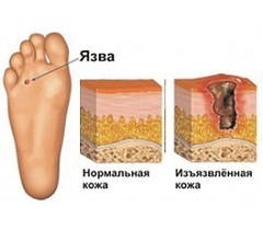 Trophic ulcer on the leg causes