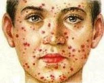 tuberkulose hud symptomer