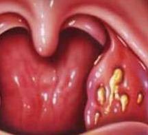 Purulent sore throat