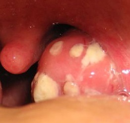 Chronic tonsillitis symptoms