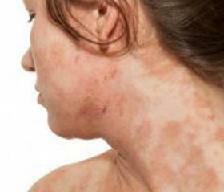 Microbial eczema photo