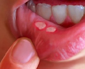 Objawy zapalenia jamy ustnej