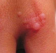 Warts on the hands