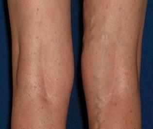 Varicose veins on legs photo