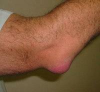 Bursitis of the elbow joint symptoms