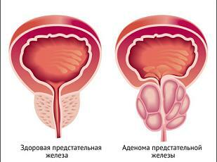 Adenom av prostata