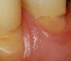 Cuneoidowy defekt zęba
