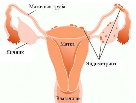 Az endometriózis okozza