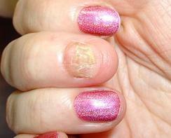 nail fungus on the hands of the symptoms