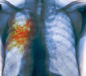 Tuberculosis of lung causes