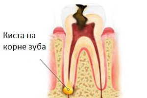 Cyst on the root of the tooth