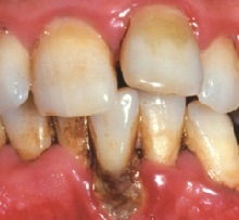 parodontiitti