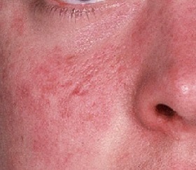 صورة من التهاب الجلد على الوجه