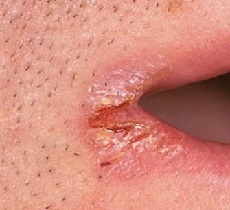 Zaeda u kutovima liječenja usta