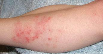 Dermatitis de contacto alérgica