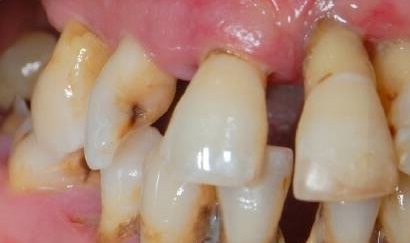 Fotos de la parodontosis