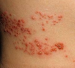 Herpes on the body - causes and treatment
