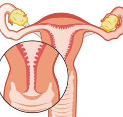Biopsija grlića maternice