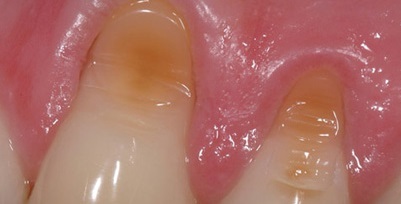 Klinovitá defekt symptómov zubov