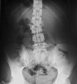 osteocondrosis de la radiografía lumbar