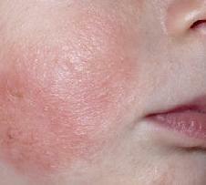 Atopic dermatitis symptoms