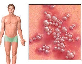 genitálny herpes 2