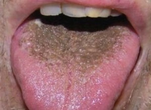Čierny plak v jazyku: príčiny a liečba