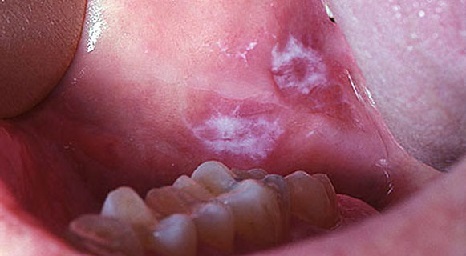 Leukoplakia zdravljenje z ustno votlino