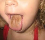 Brown plaque on tongue treatment