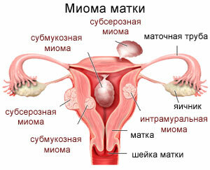 Myóma maternice spôsobuje