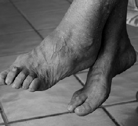 Jalkojen osteoartriitti