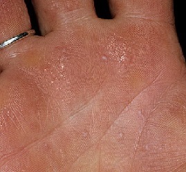 Dyshidrotic eczema on the hands