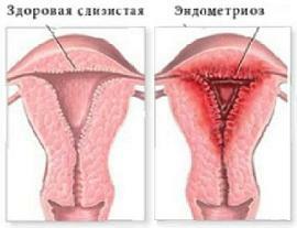 Endometrios symptom